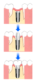 インプラントの図